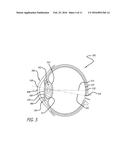 REAL-TIME SURGICAL REFERENCE INDICIUM APPARATUS AND METHODS FOR     INTRAOCULAR LENS IMPLANTATION diagram and image