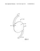 REAL-TIME SURGICAL REFERENCE INDICIUM APPARATUS AND METHODS FOR     INTRAOCULAR LENS IMPLANTATION diagram and image