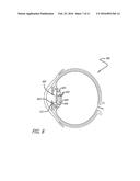 REAL-TIME SURGICAL REFERENCE INDICIUM APPARATUS AND METHODS FOR     INTRAOCULAR LENS IMPLANTATION diagram and image