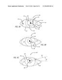 REAL-TIME SURGICAL REFERENCE INDICIUM APPARATUS AND METHODS FOR     INTRAOCULAR LENS IMPLANTATION diagram and image