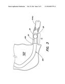 STABILIZING AND SEALING CATHETER FOR USE WITH A GUIDING CATHETER diagram and image