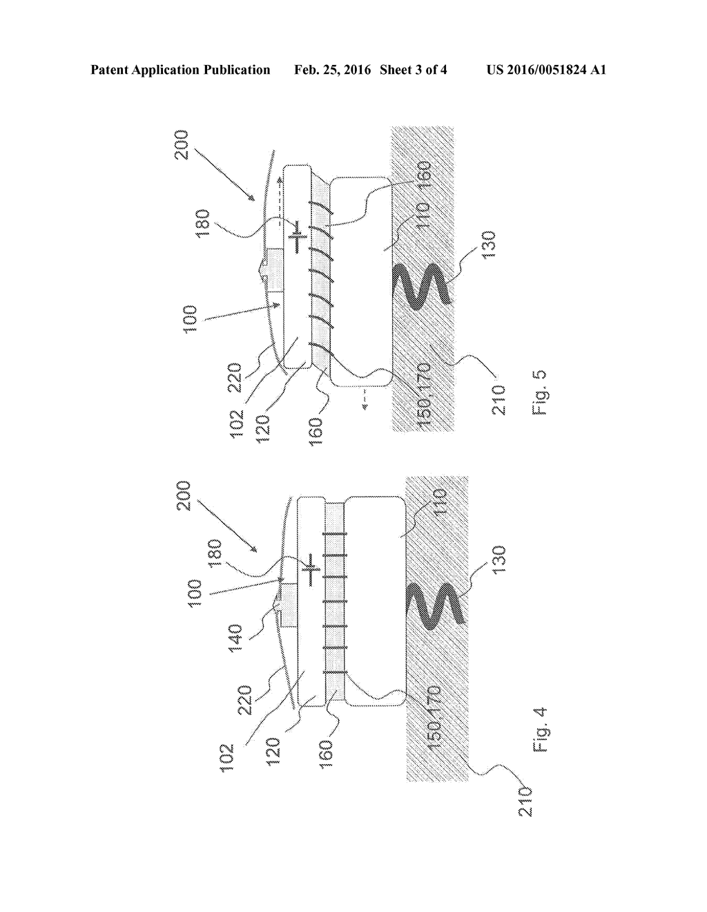 MEDICAL IMPLANT - diagram, schematic, and image 04