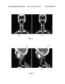 Image-Guided Radiotherapy For Internal Tumor Boost diagram and image