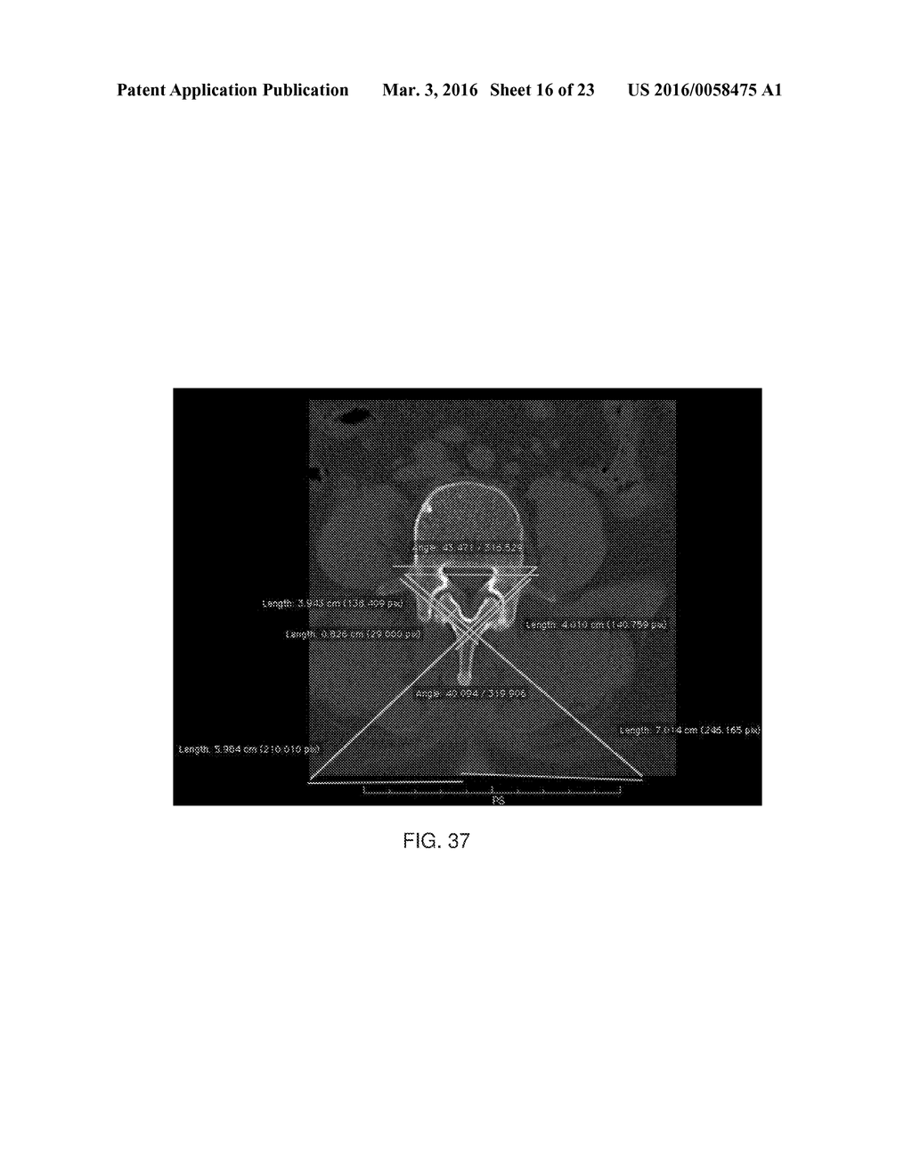 Polymer Osteosynthesis/Translaminar Screw for Surgical Spine Treatment - diagram, schematic, and image 17