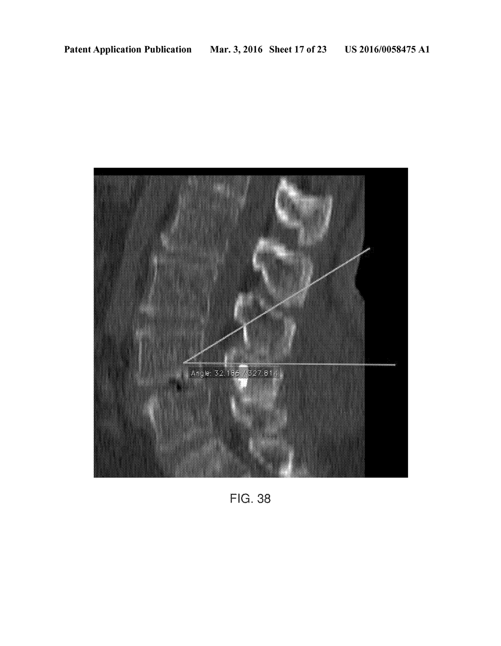 Polymer Osteosynthesis/Translaminar Screw for Surgical Spine Treatment - diagram, schematic, and image 18