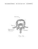 Stabilized Spinal Fixation Device diagram and image