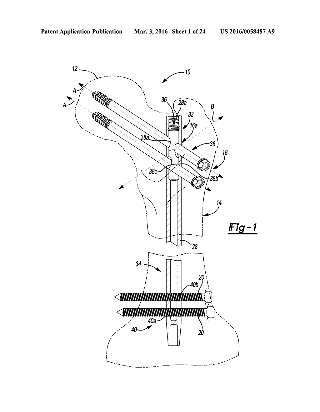 METHOD AND APPARATUS FOR ORTHOPEDIC FIXATION - diagram, schematic, and image 02