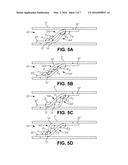 LOW PROFILE INTRALUMINAL MEDICAL DEVICES diagram and image