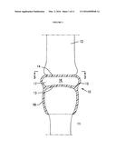 RESILIENT MEDICALLY INFLATABLE INTERPOSITIONAL ARTHROPLASTY DEVICE diagram and image