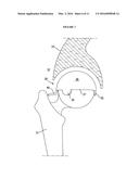 RESILIENT MEDICALLY INFLATABLE INTERPOSITIONAL ARTHROPLASTY DEVICE diagram and image