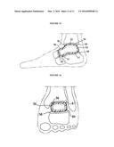 RESILIENT MEDICALLY INFLATABLE INTERPOSITIONAL ARTHROPLASTY DEVICE diagram and image