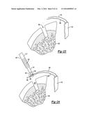 KNOTLESS GRAFT FIXATION ASSEMBLY diagram and image