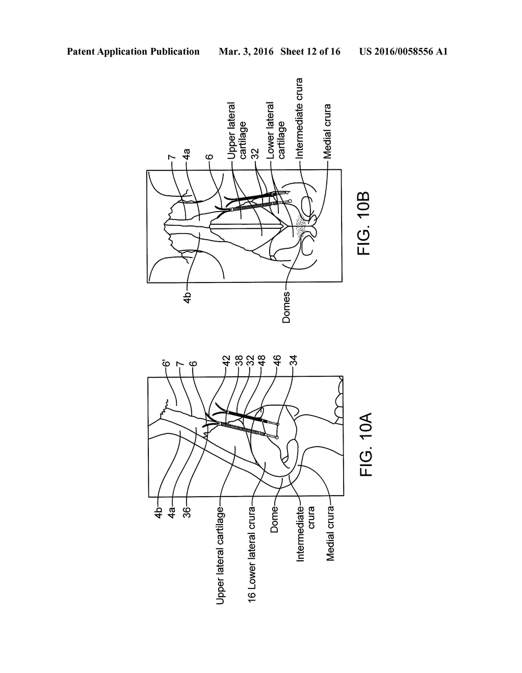 NASAL IMPLANTS AND SYSTEMS AND METHOD OF USE - diagram, schematic, and image 13