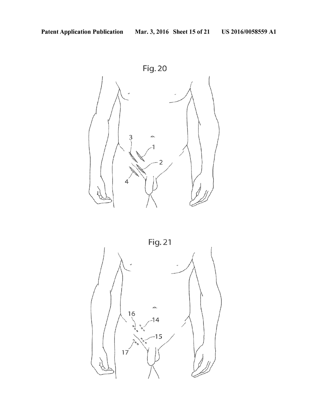 HIP JOINT DEVICE AND METHOD - diagram, schematic, and image 16