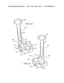 TIBIAL AUGMENTS FOR USE WITH KNEE JOINT PROSTHESES, METHOD OF IMPLANTING     THE TIBIAL AUGMENT, AND ASSOCIATED TOOLS diagram and image