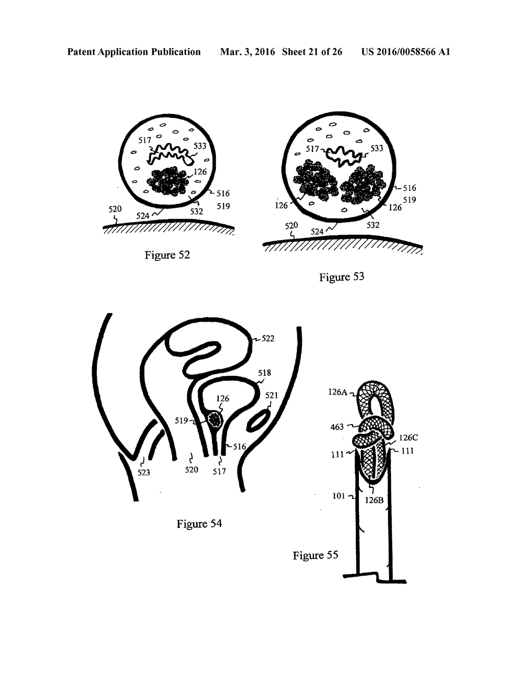 Method for tissue repair with spirals of filament - diagram, schematic, and image 22