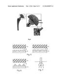 DEVICE TO BE IMPLANTED IN HUMAN OR ANIMAL TISSUE AND METHOD FOR IMPLANTING     AND ASSEMBLING THE DEVICE diagram and image