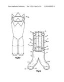 PERCUTANEOUS ENDOVASCULAR APPARATUS FOR REPAIR OF ANEURYSMS AND ARTERIAL     BLOCKAGES diagram and image