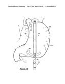 BARIATRIC CLAMP WITH SUTURE PORTIONS, MAGNETIC INSERTS AND CURVATURE diagram and image