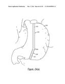 BARIATRIC CLAMP WITH SUTURE PORTIONS, MAGNETIC INSERTS AND CURVATURE diagram and image