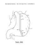 BARIATRIC CLAMP WITH SUTURE PORTIONS, MAGNETIC INSERTS AND CURVATURE diagram and image