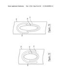 BARIATRIC CLAMP WITH SUTURE PORTIONS, MAGNETIC INSERTS AND CURVATURE diagram and image