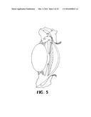 DEVICE AND METHOD FOR REDUCING INTRAOCULAR PRESSURE diagram and image