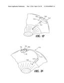 DEVICE AND METHOD FOR REDUCING INTRAOCULAR PRESSURE diagram and image