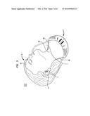 External Ear Canal Pressure Regulation System diagram and image