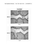 SEX STEROID PRECURSORS ALONE OR IN COMBINATION WITH SELECTIVE ESTROGEN     RECEPTOR MODULATORS FOR THE PREVENTION AND TREATMENT OF DYSPAREUNIA IN     POSTMENOPAUSAL WOMEN diagram and image