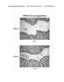 SEX STEROID PRECURSORS ALONE OR IN COMBINATION WITH SELECTIVE ESTROGEN     RECEPTOR MODULATORS FOR THE PREVENTION AND TREATMENT OF DYSPAREUNIA IN     POSTMENOPAUSAL WOMEN diagram and image