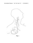 PADDLE LEADS CONFIGURED FOR SUTURE FIXATION diagram and image