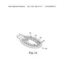 PADDLE LEADS CONFIGURED FOR SUTURE FIXATION diagram and image