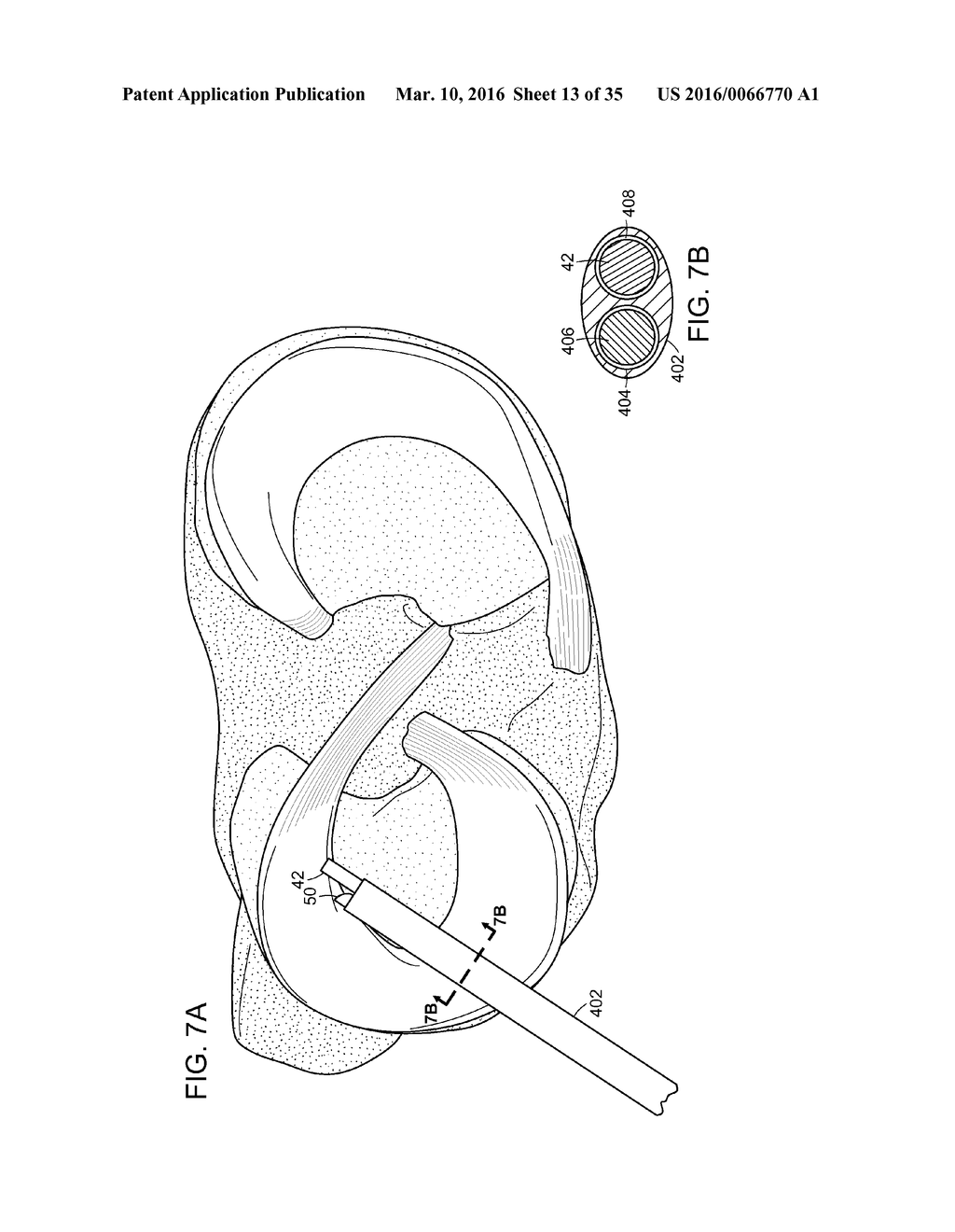 DEVICES AND METHODS FOR MINIMALLY INVASIVE ARTHROSCOPIC SURGERY - diagram, schematic, and image 14