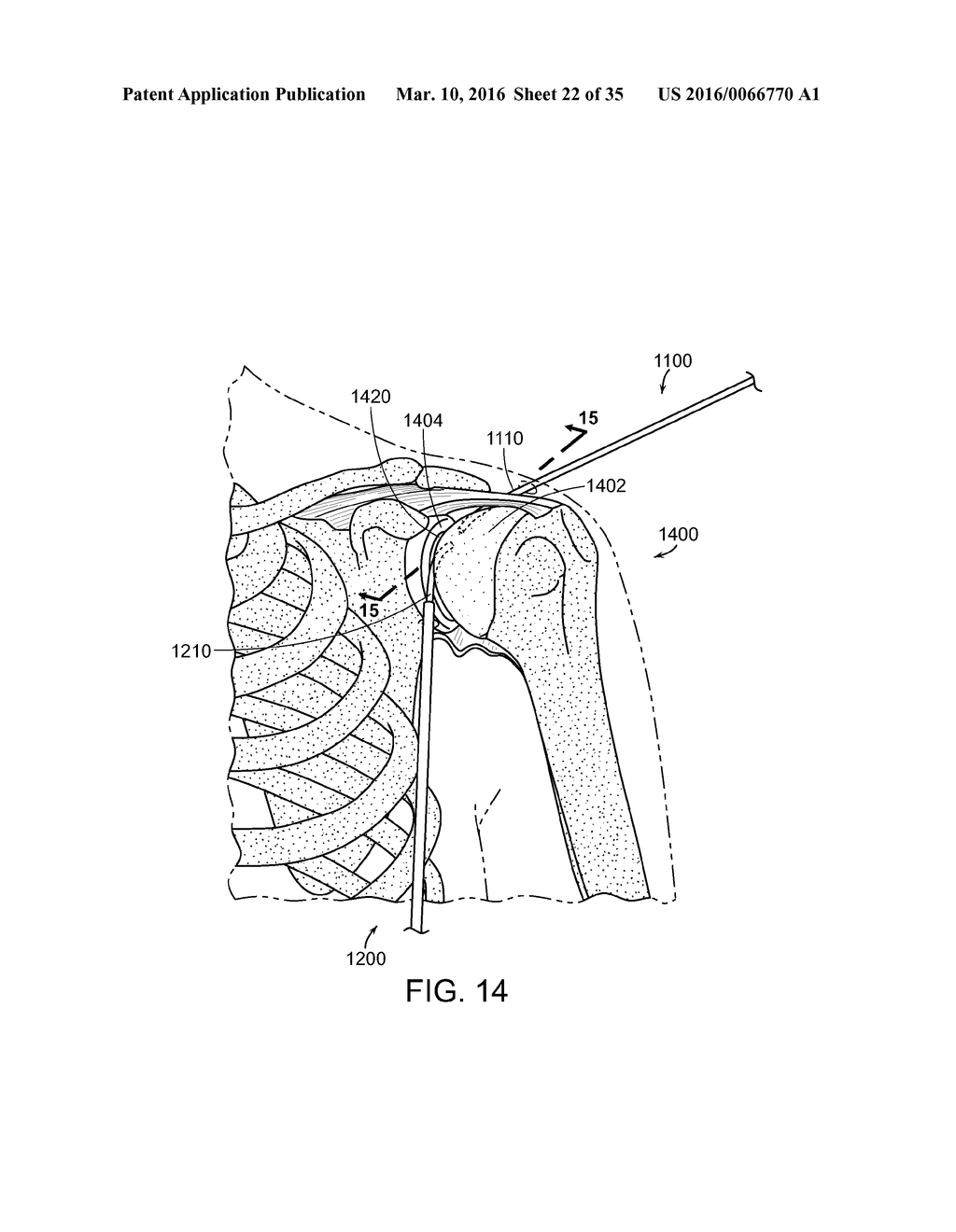 DEVICES AND METHODS FOR MINIMALLY INVASIVE ARTHROSCOPIC SURGERY - diagram, schematic, and image 23