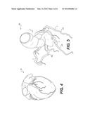 METHOD AND SYSTEM FOR QUANTIFYING LIMITATIONS IN CORONARY ARTERY BLOOD     FLOW DURING PHYSICAL ACTIVITY IN PATIENTS WITH CORONARY ARTERY DISEASE diagram and image