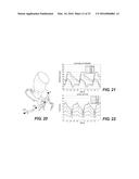 METHOD AND SYSTEM FOR QUANTIFYING LIMITATIONS IN CORONARY ARTERY BLOOD     FLOW DURING PHYSICAL ACTIVITY IN PATIENTS WITH CORONARY ARTERY DISEASE diagram and image