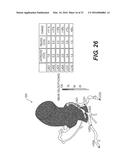 METHOD AND SYSTEM FOR QUANTIFYING LIMITATIONS IN CORONARY ARTERY BLOOD     FLOW DURING PHYSICAL ACTIVITY IN PATIENTS WITH CORONARY ARTERY DISEASE diagram and image