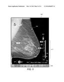 Displaying Computer-Aided Detection Information With Associated Breast     Tomosynthesis Image Information diagram and image