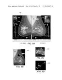 Displaying Computer-Aided Detection Information With Associated Breast     Tomosynthesis Image Information diagram and image