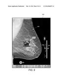 Displaying Computer-Aided Detection Information With Associated Breast     Tomosynthesis Image Information diagram and image