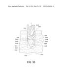 SUTURE ANCHOR diagram and image