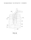 SUTURE ANCHOR diagram and image