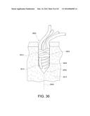 SUTURE ANCHOR diagram and image