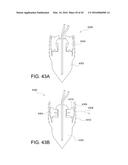 SUTURE ANCHOR diagram and image