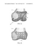 ADAPTIVE SURFACE SURGICAL GUIDING APPARATUS AND SYSTEMS AND METHODS OF     MANUFACTURING ADAPTIVE SURFACE SURGICAL GUIDING APPARATUS diagram and image