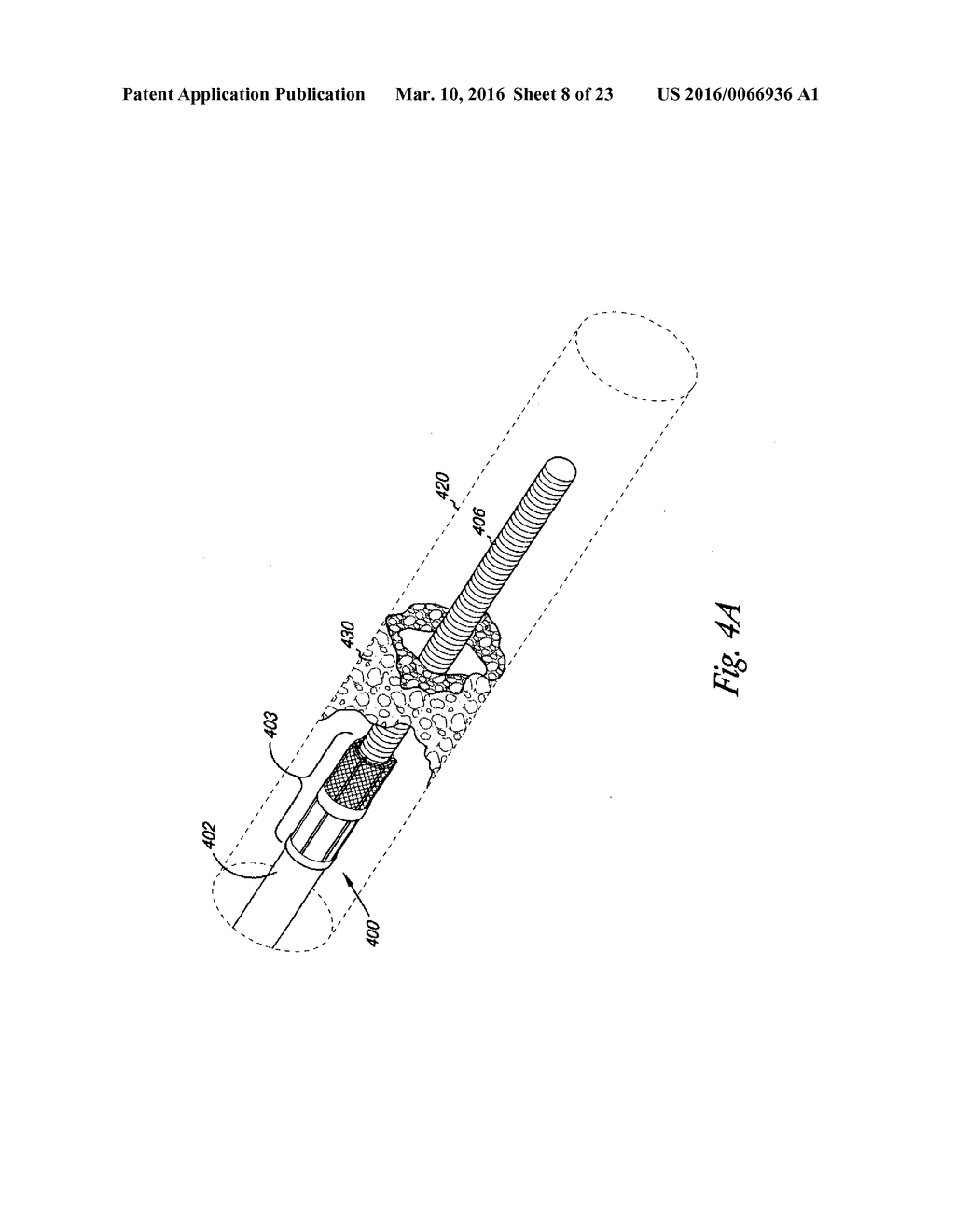 VESSEL OCCLUDING MATERIAL EXTRACTOR - diagram, schematic, and image 09