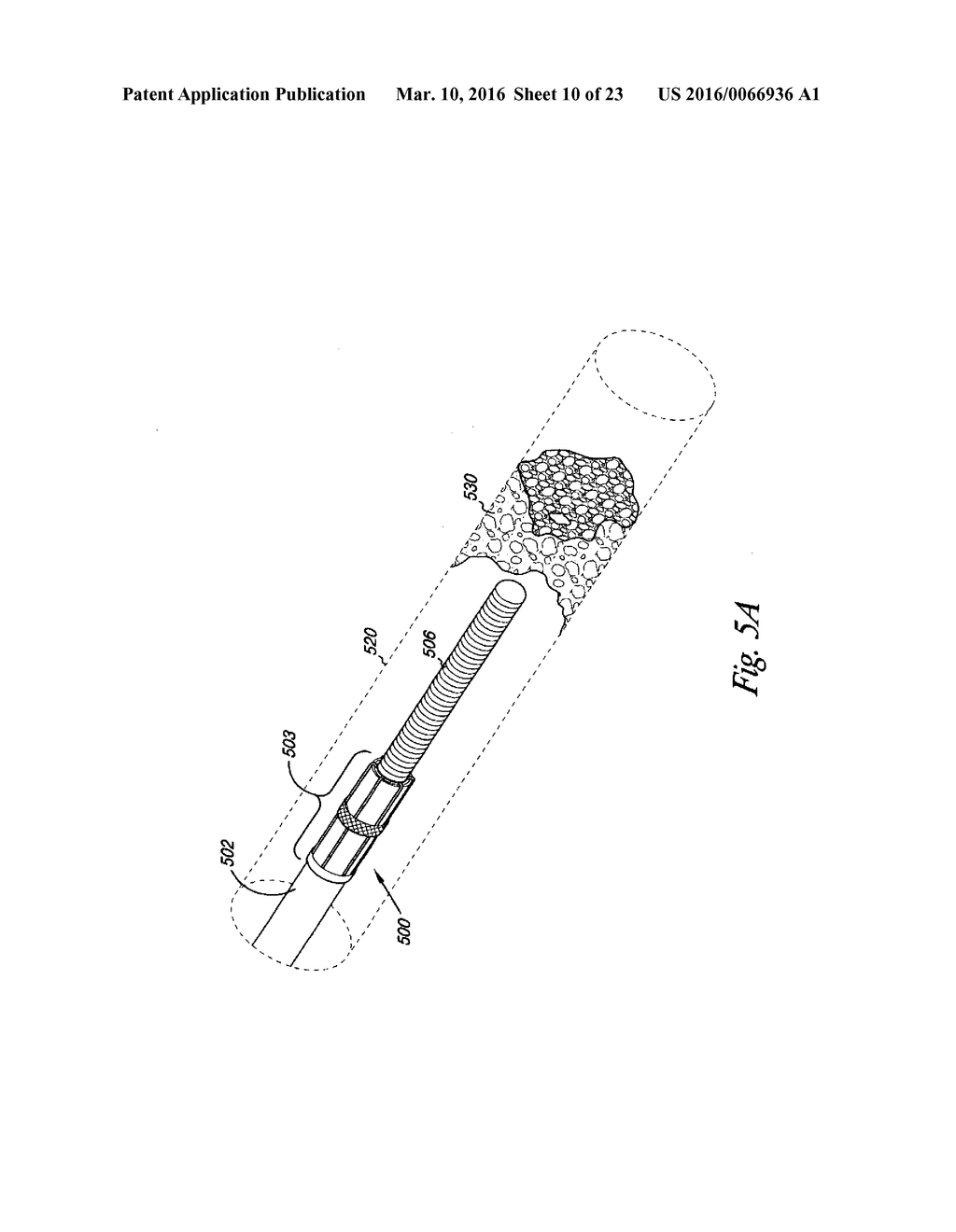 VESSEL OCCLUDING MATERIAL EXTRACTOR - diagram, schematic, and image 11