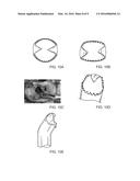 DISCECTOMY KITS WITH AN OBTURATOR, GUARD CANNULA diagram and image