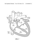 CRYOADHESIVE DEVICE FOR LEFT ATRIAL APPENDAGE OCCLUSION diagram and image